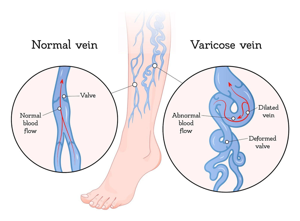Remedies For Varicose Veins
